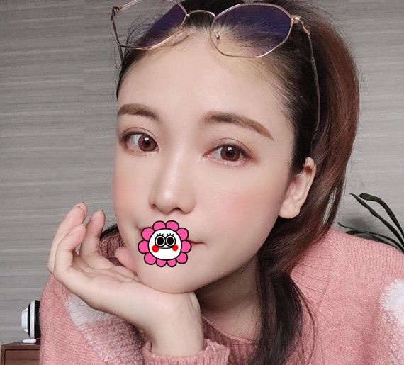 听说温科磊坐诊杭州薇琳而且他做的双眼皮自然灵动是真的吗? 图2