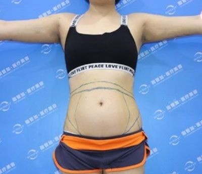 在泉州脂管加找邵起民做吸脂瘦腰腹三个月后高兴的要飞起来