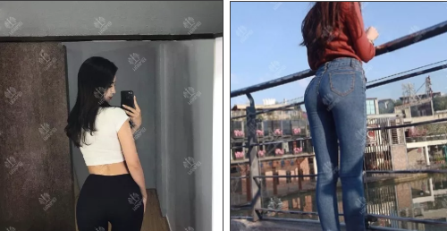 遵义韩美整形公开一位屁股扁平妹子做自体脂肪丰臀三个月后效果图。 图2