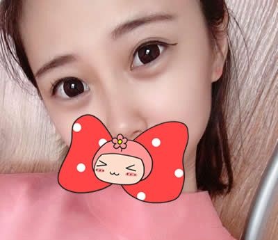 自从找泉州欧菲胡利韬主任做完双眼皮后我真的是赚足了回头率 图2
