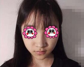 塌鼻子的我在长沙梵童医疗美容做完鼻综合后终于拥有立体小翘鼻!