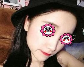 塌鼻子的我在长沙梵童医疗美容做完鼻综合后终于拥有立体小翘鼻! 图2