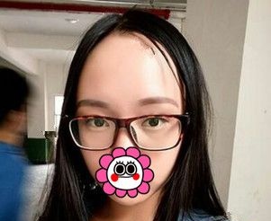 还在担心去眼袋手术后遗症的你看小姐姐在连云港做的内切法出血少，也没有松弛和凹陷感啊