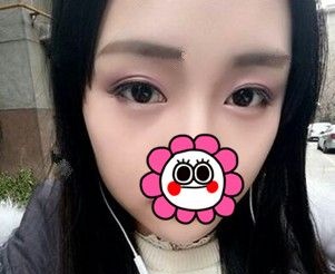 还在担心去眼袋手术后遗症的你看小姐姐在连云港做的内切法出血少,也没有松弛和凹陷感啊 图2