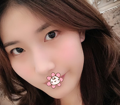 之所以来珠海新颜找苏锦和做双眼皮是因为身边好几个朋友都是找他做的眼睛效果很自然