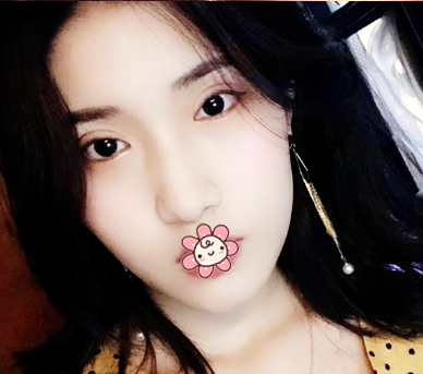 之所以来珠海新颜找苏锦和做双眼皮是因为身边好几个朋友都是找他做的眼睛效果很自然 图2