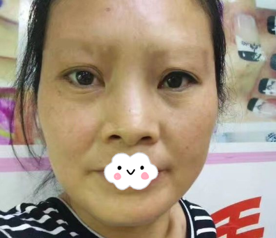 成都成美张莉主任建议我做线雕隆鼻和面部埋线提升，原来我也可以这么年轻漂亮