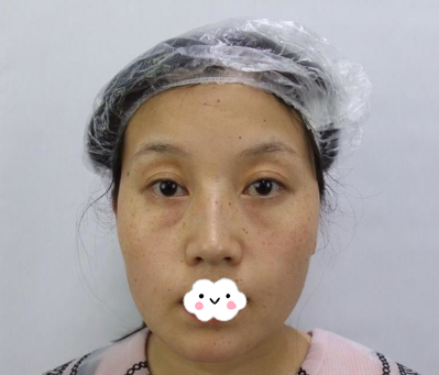 成都美容整形医院任华英给我做的激光祛斑效果比我抹祛斑霜强多了