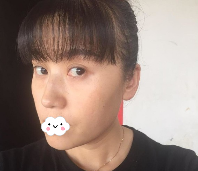 成都美容整形医院任华英给我做的激光祛斑效果比我抹祛斑霜强多了 案例图2