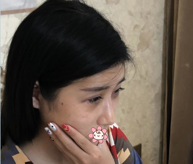 上次找佛山华美雷朝勇做的双眼皮修复很成功这次又来做了祛眼袋效果也是没的说