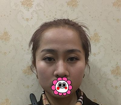 找杭州艺星付德刚做完鼻综合后改变了我的驼峰鼻