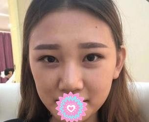 在洛阳做了纹眉后感觉服务周到、价格亲民又来做了肋软骨隆鼻