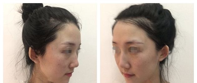 怎么淡斑祛斑?南通李冬颖医生面诊我和闺蜜的黄褐斑和晒斑建议了辉煌360祛除