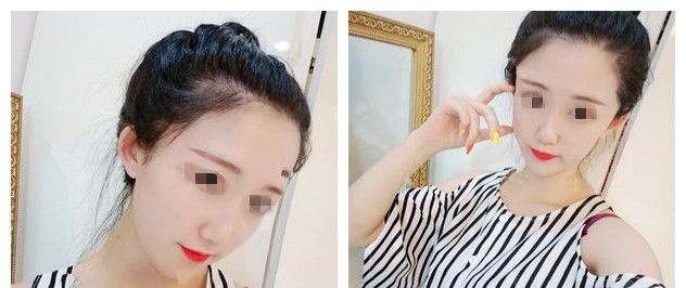 怎么淡斑祛斑?南通李冬颖医生面诊我和闺蜜的黄褐斑和晒斑建议了辉煌360祛除 图2