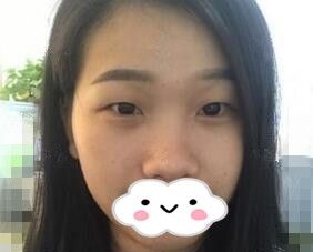 还在纠结鼻综合和眼综合要不要一起做，看我在海南华美做的效果变化不要太大哦！
