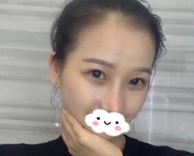 还在纠结鼻综合和眼综合要不要一起做,看我在海南华美做的效果变化不要太大哦! 图2