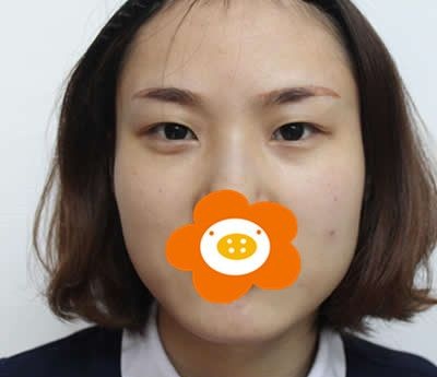 在泉州西华做了切开双眼皮+开眼角半年后眼部线条简直美呆了