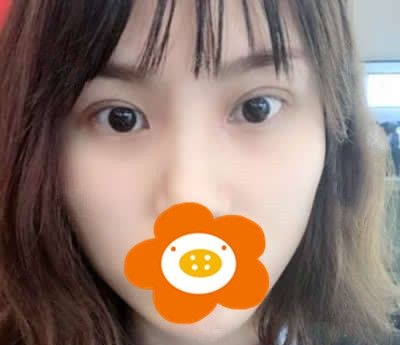 在泉州西华做了切开双眼皮+开眼角半年后眼部线条简直美呆了 图2