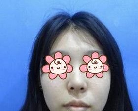 论下巴的重要性:分享我在沈阳名流美容医院做硅胶假体垫下巴恢复过程效果图!