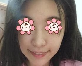 论下巴的重要性:分享我在沈阳名流美容医院做硅胶假体垫下巴恢复过程效果图! 图2