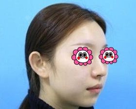 在长沙口碑好的雅美医疗美容医院做了玻尿酸丰下巴后效果比我预期的还好!