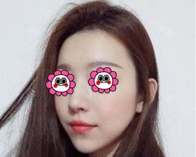 在长沙口碑好的雅美医疗美容医院做了玻尿酸丰下巴后效果比我预期的还好! 图2