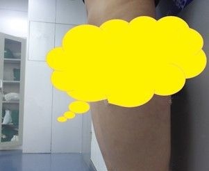 在3000ML的安全吸脂量范围内打听到连云港华美的瘦大腿吸脂手术价格才确定做了