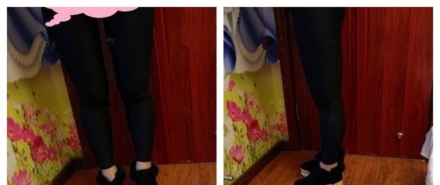 在3000ML的安全吸脂量范围内打听到连云港华美的瘦大腿吸脂手术价格才确定做了 案例图2