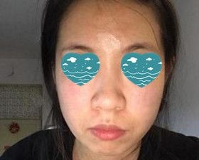 在沈阳元辰医美做的硅胶假体垫下巴一个月后恢复效果还挺自然的!