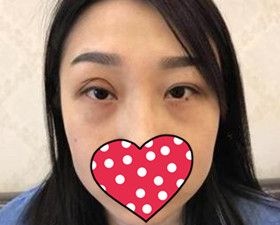 得知沈阳名流美容医院不仅口碑好而且做双眼皮价格也很亲民后我就做了双眼皮修复术!