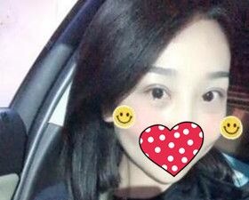 得知沈阳名流美容医院不仅口碑好而且做双眼皮价格也很亲民后我就做了双眼皮修复术！ 案例图2