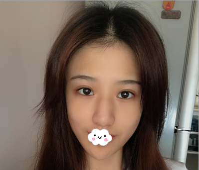 内江达芬奇邓子力给我做驼峰鼻矫正的时候用耳软骨垫鼻尖,术后可以揉捏超级自然