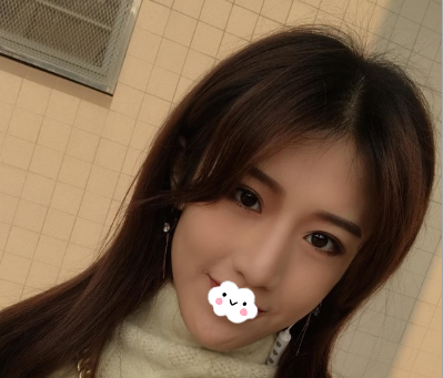 内江达芬奇邓子力给我做驼峰鼻矫正的时候用耳软骨垫鼻尖,术后可以揉捏超级自然 图2