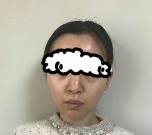 2年内鼻子做了3次,终于在赣州薇琳医疗美容成功做了隆鼻失败修复手术我才如释负重
