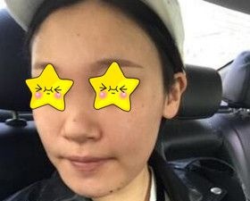 我在大连爱德丽格做的鼻综合+自体脂肪填充面部效果很不错,大家看看觉得怎么样?