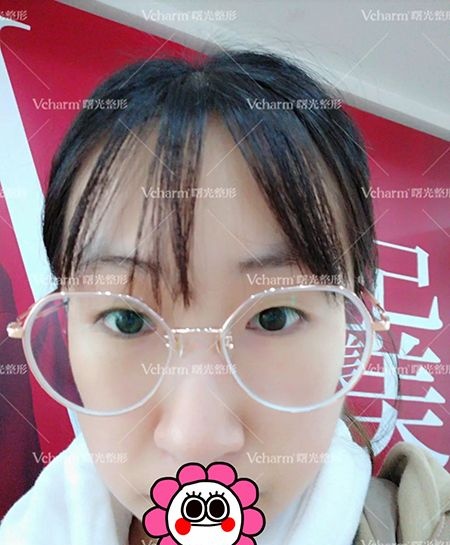 嘉兴曙光王艳为我做的双眼皮+开内眼角术后恢复45天实现我的网红眼梦想