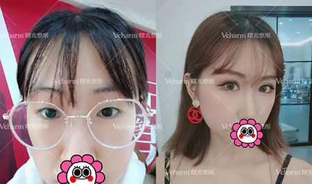 嘉兴曙光王艳为我做的双眼皮+开内眼角术后恢复45天实现我的网红眼梦想 图2
