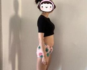 讲述我找大连新华美天医疗美容医院王建做大腿吸脂的亲身经历!
