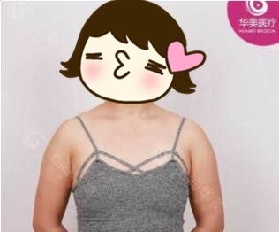 隆胸假体应该如何选?我在上海华美找李健做傲诺拉闪耀圆形假体325cc