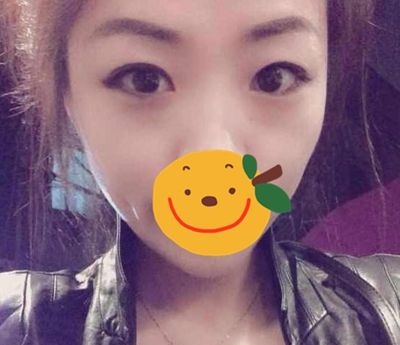 经过了一场在驻马店的眼部综合手术 一个月后我的内双大小眼得到拯救