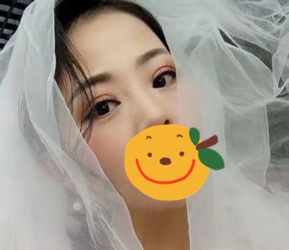 经过了一场在驻马店的眼部综合手术 一个月后我的内双大小眼得到拯救 图2