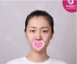 对之前割过双眼皮形状不满意的我在上海丽质做了眼修复价格优惠效果好