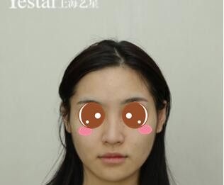 鼓足勇气的我在上海艺星做了鼻综合后给大家看看术后恢复效果图