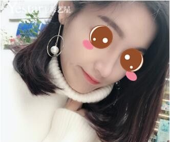 鼓足勇气的我在上海艺星做了鼻综合后给大家看看术后恢复效果图 图2