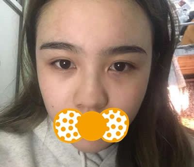 快看!我难看的大蒜鼻在泉州欧菲做了耳软骨综合隆鼻后回头率暴涨