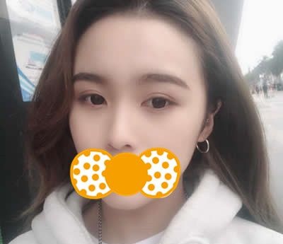 快看!我难看的大蒜鼻在泉州欧菲做了耳软骨综合隆鼻后回头率暴涨 图2