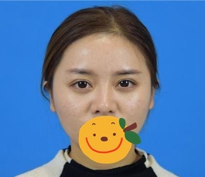 上传我在洛阳做鼻综合术后1-7天的照片 30天后的我颜值翻翻