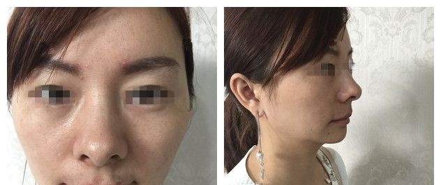 意大利悦升线维持时间久，但对比价格还是选了连云港华美医生做美国美迪塑PPDO，术后提拉抗衰效果不错