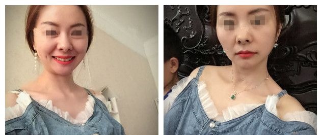 意大利悦升线维持时间久,但对比价格还是选了连云港华美医生做美国美迪塑PPDO,术后提拉抗衰效果不错 图2