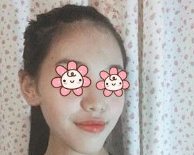 把我在湘潭雅美做自体脂肪丰额头太阳穴术后45天恢复效果图跟大家分享一下！